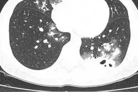 咳一周查出肺里好多洞！30岁女子中招“隐形杀手”，死亡率高达80%！图片