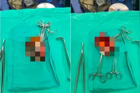 云南一女子脸上长“大包”，内有大量蛆虫蠕动……医生提醒：出现这些症状别大意图片