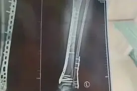 太危险！女子摔成粉碎性骨折，原因竟在这种“夏日必备”？图片