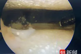 男子膝盖内“长”满痛风结石，医生“刮骨”半小时清除图片