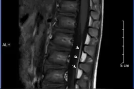 6岁娃常尿床，问题竟在一根细丝！图片