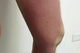 虫咬后涂抹风油精导致“伤”上加“伤”，专家提醒千万别乱涂！图片