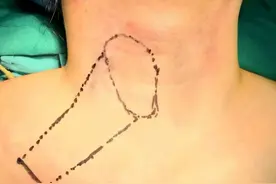 手术切口能“隐身” 健康美丽两不误图片