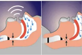 美梦中隐藏的“杀手”——睡眠呼吸暂停综合征图片