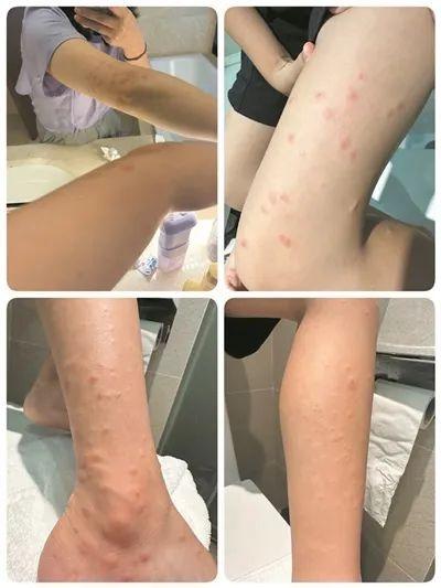 去趟江心屿满腿包？