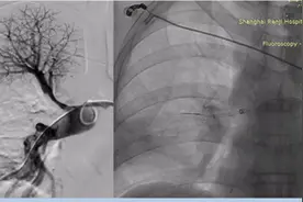 血栓，吸出来！仁济医院采用新一代微创器械挽救急性肺梗患者生命图片