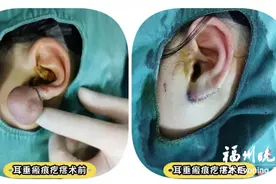 福州一女孩打耳洞 耳垂长出大肉疙瘩图片