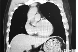 罕见“镜面人”长肿瘤 医生反向精准“拆弹”图片