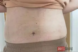 “脆皮”大学生一个蹲起后就站不起来，原是腰椎间盘突出图片