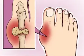 世界痛风日：坚持规范化治疗，痛风石也能消失！图片