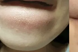 下巴上凸起的白色小颗粒是什么？想自己抠掉？劝你住手！图片