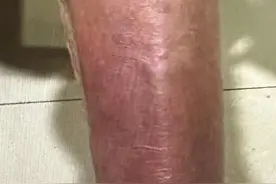 被秋蚊子咬了一口，小腿都黑了，还肿胀破溃！这是咋了？图片