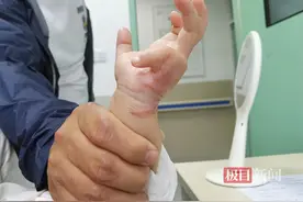 1岁宝宝烫伤手指，疤痕挛缩严重，医生提醒烫伤后应这样处理图片
