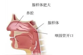 腺样体肥大要做手术吗？图片