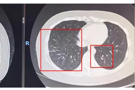 孩子感染支原体肺炎，妈妈也“中招”！专家提醒：家庭防治关键在于提高免疫力图片