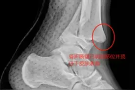 13岁篮球少年比赛中受伤，医生：运动前充分热身至关重要图片