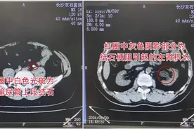 男子突发左腰胀痛伴血尿，连做3次体外碎石无效方紧急就医图片