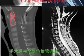 福建7岁男童，突然高位截瘫！这病严重可致命！图片