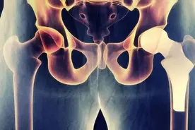 直播大医生：别让股骨头受了伤图片