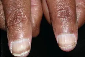 指甲月牙小、有竖纹，就是不健康？错！这些真相一定要知道图片