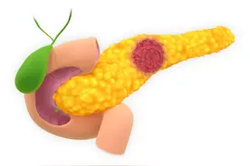 左上腹部隐痛或胀痛，大便奇臭！当心“癌中之王”胰腺癌图片