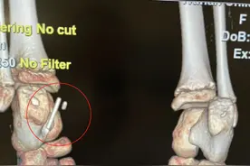 骨科连收11名外伤孩子！3cm铅笔扎进8岁女孩脚里，医生紧急提醒图片