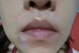 使用脱毛膏导致烧伤！专家：敏感部位更易引起不良反应图片