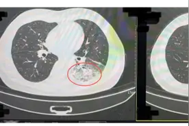 冷气续命变索命？成都一男子吹空调致“白肺”，敲响夏季空调使用健康警钟！图片