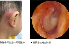 今年家长真难！孩子肺炎没好，又诱发中耳炎，多名儿童中招图片