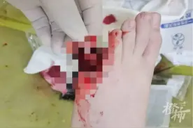 又是它！8岁男孩脚趾被夹断，曾有多人“中招”图片