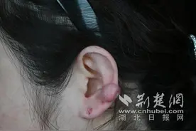 女子长年戴耳环不摘 双耳竟变形“结葡萄”图片