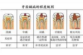 长沙市口腔医院补牙、治龋齿（虫牙），医保能报销80%！图片
