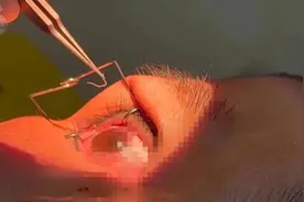 女子双眼取出60多条活虫，很多人都有这个习惯图片