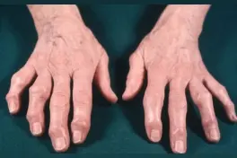 手关节肿痛僵硬畸形？勿把骨关节炎当成类风湿！图片