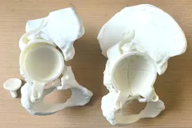 全省首例可视化智能导航系统辅助下复杂全髋关节翻修术在青完成图片