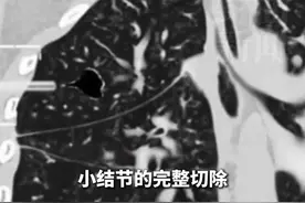 华西医院全球首创！不开刀 超微创穿刺精准切除肺小结节图片