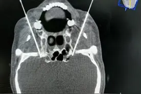 控制不住的“挤眉弄眼”或藏隐患 需警惕梅杰氏综合征图片