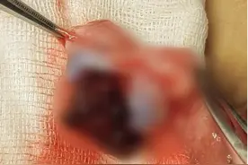 10岁男孩的蛋蛋，被同学一脚踢碎……医生：每月接诊二三十例图片