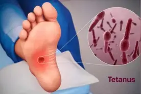 破伤风，看得见的小伤口，看不见的大隐患！图片