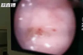 17岁少女肠道内布满寄生虫，还活蹦乱跳的！医生都吓一跳……图片