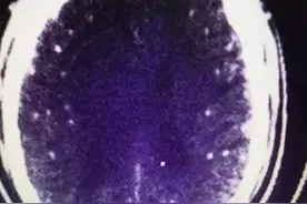 吃火锅时出了一个错，虫子钻进“脑子里”！有图为证，你还敢乱吃吗？图片