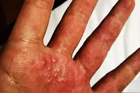 抗疫志愿者的手你见过吗？长期戴两双手套捂出满手湿疹图片