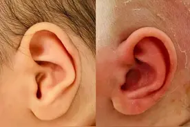 一周连遇5个耳朵畸形宝宝，专家：别错过矫正“黄金期”图片