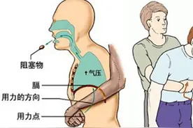异物卡喉先别慌，海姆立克来帮忙图片