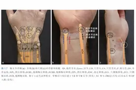 一文读懂，腕关节镜入路的技巧图片