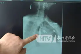 杭州一90岁老太只能坐着睡觉……这种病，这些人是高危！注意→图片