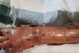 吃海鲜前这件事千万要注意！广东大爷被迫截肢……图片