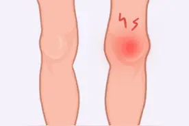 膝盖疼、腿疼、脚疼……5种跑步损伤，专家教你处理图片