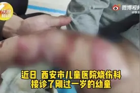 警惕！1岁男孩尿床，被电热毯烧伤图片