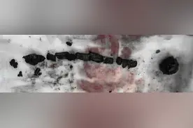 吓人！十几厘米蛔虫钻入温州老伯胆管，整条虫变成“石头”图片